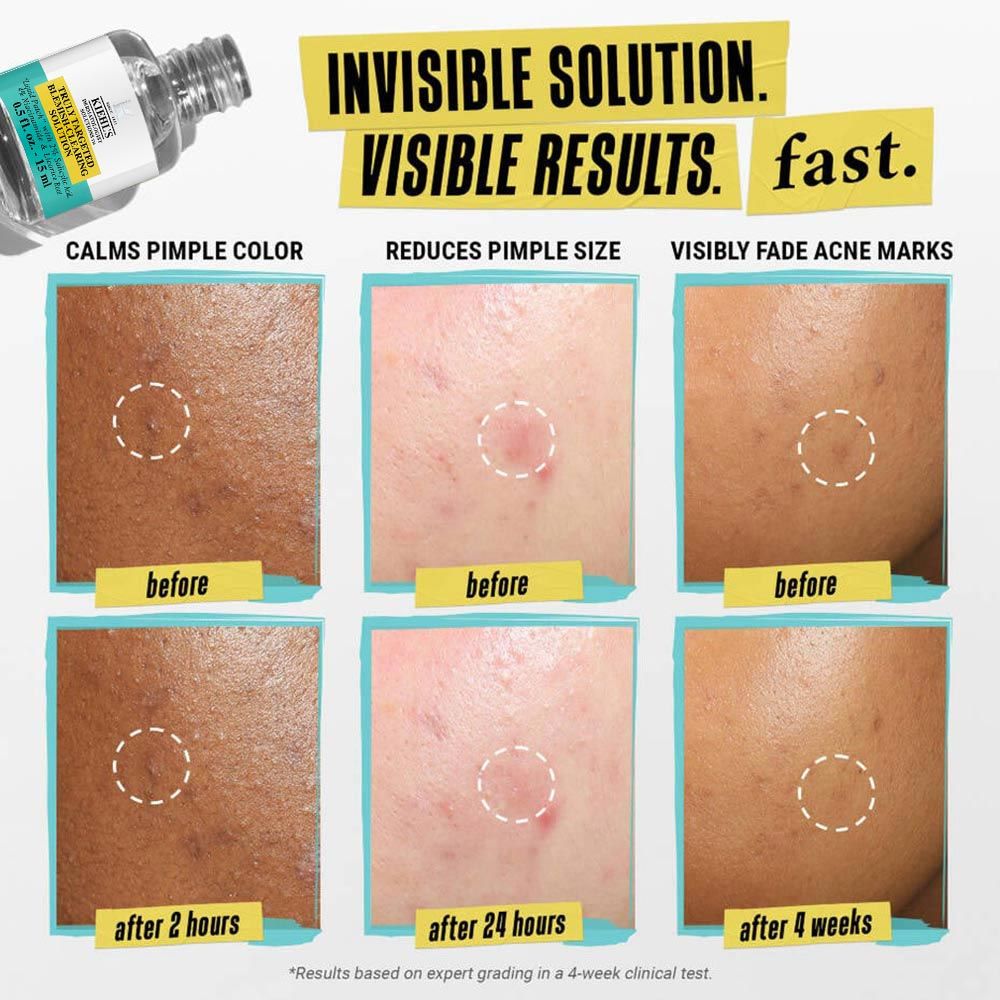 Kiehl's Truly Targeted Blemish - Clearing Solution