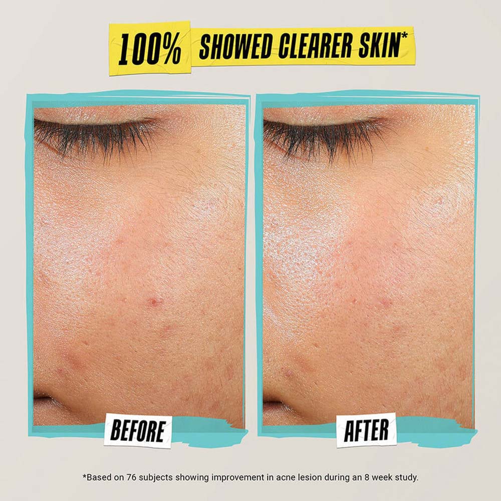 Kiehl's Expertly Clear Blemish-Treating & Preventing Lotion
