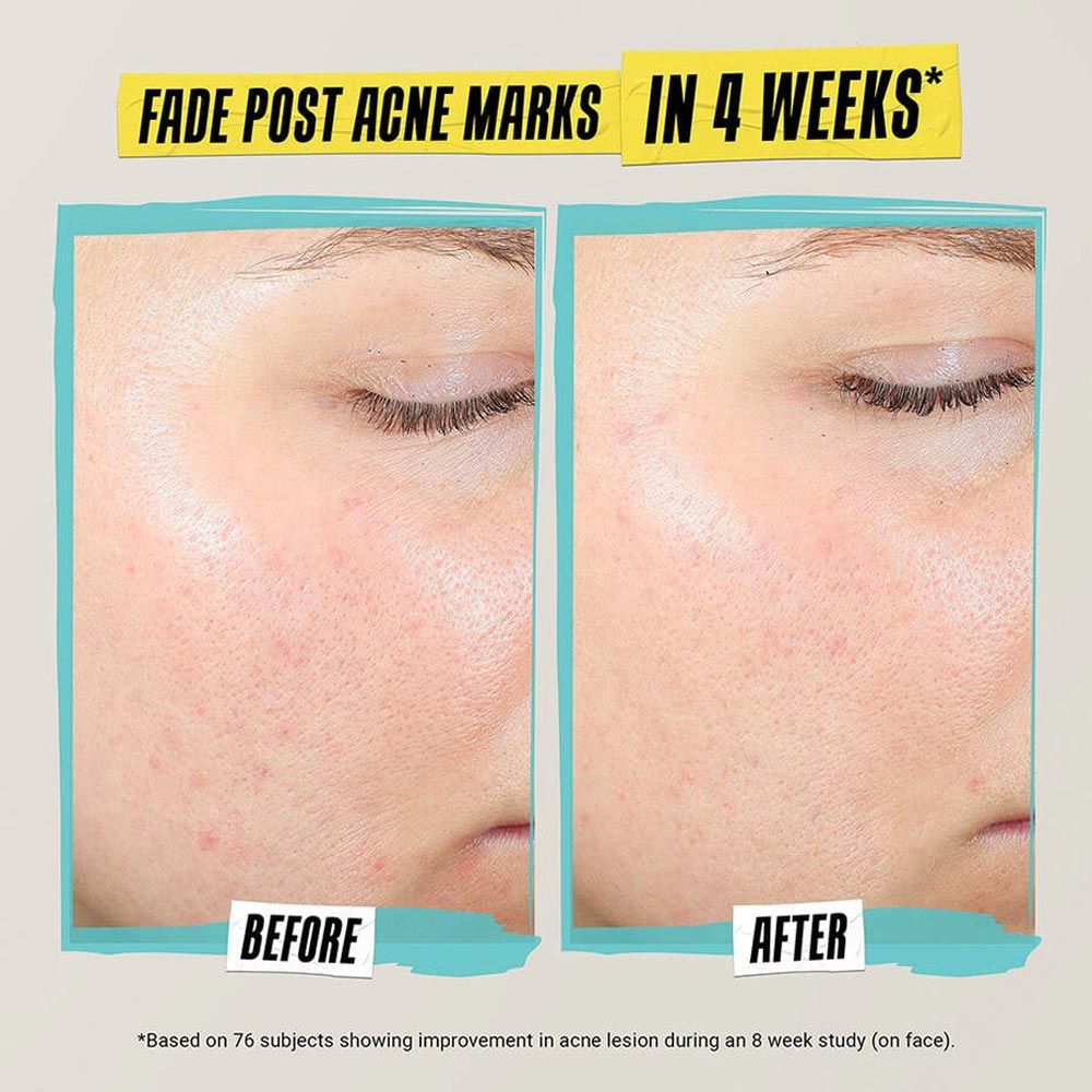 Kiehl's Expertly Clear Blemish-Treating & Preventing Lotion